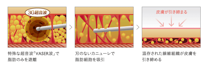 ベイザー脂肪吸引の仕組み