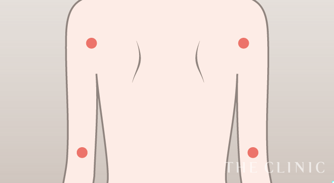 脂肪吸引の傷跡の位置（二の腕）