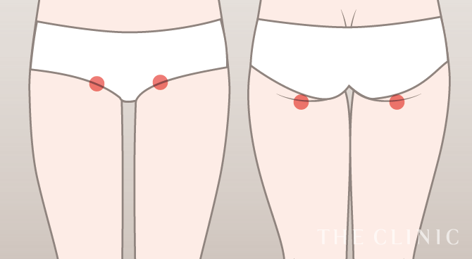 脂肪吸引の傷跡の位置（太もも）