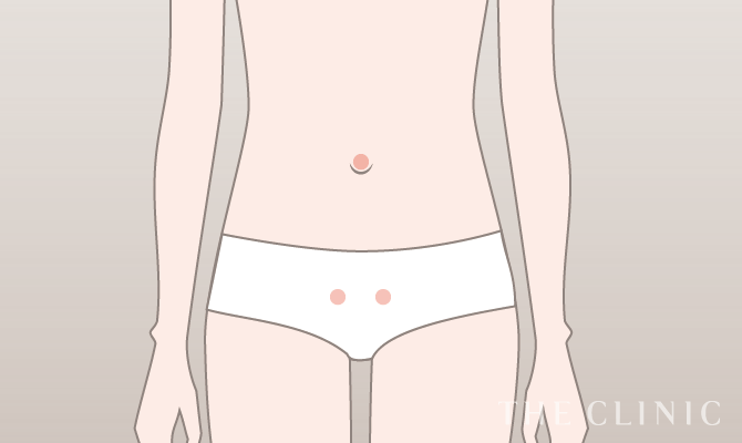 脂肪吸引の傷跡の位置（お腹）